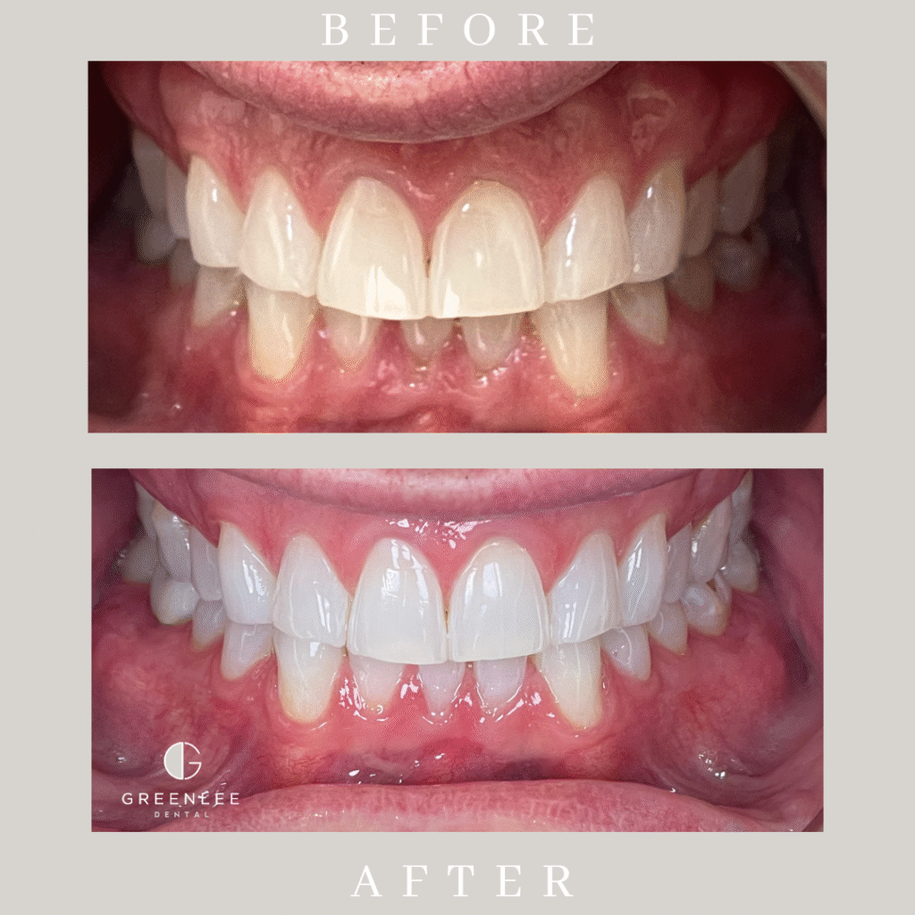 Before and after of a full smile transformed with cosmetic dentistry at Greenlee Dental