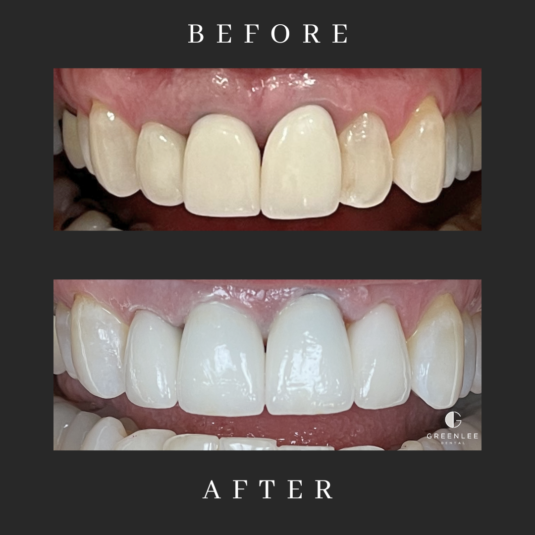 Close-up of front teeth before and after cosmetic crowns at Greenlee Dental